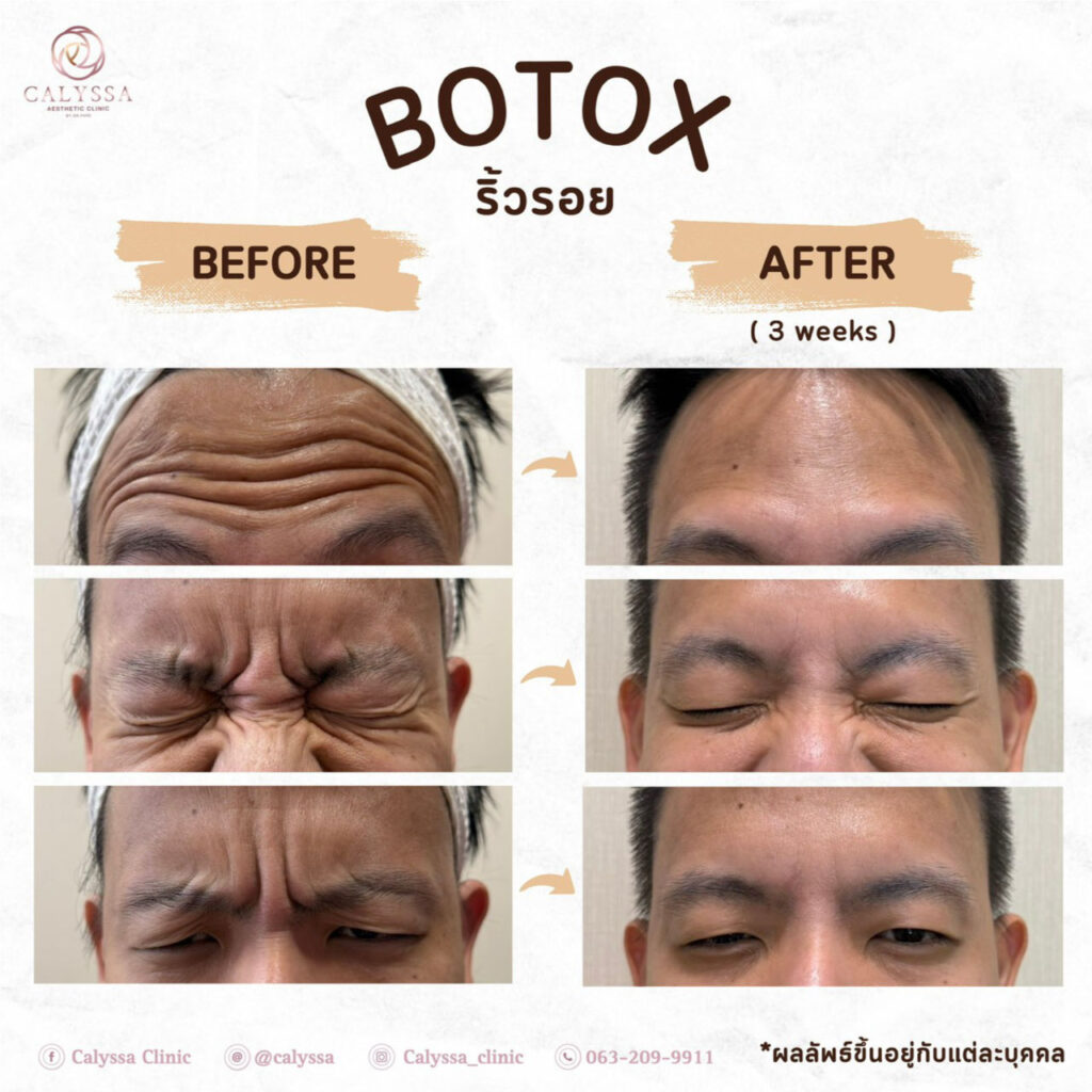 รีวิว botox