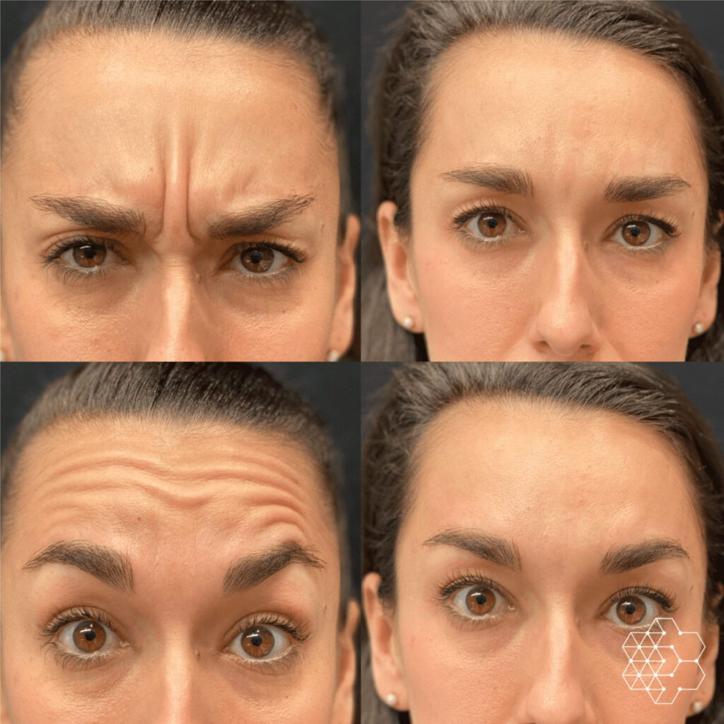 รีวิว botox 1