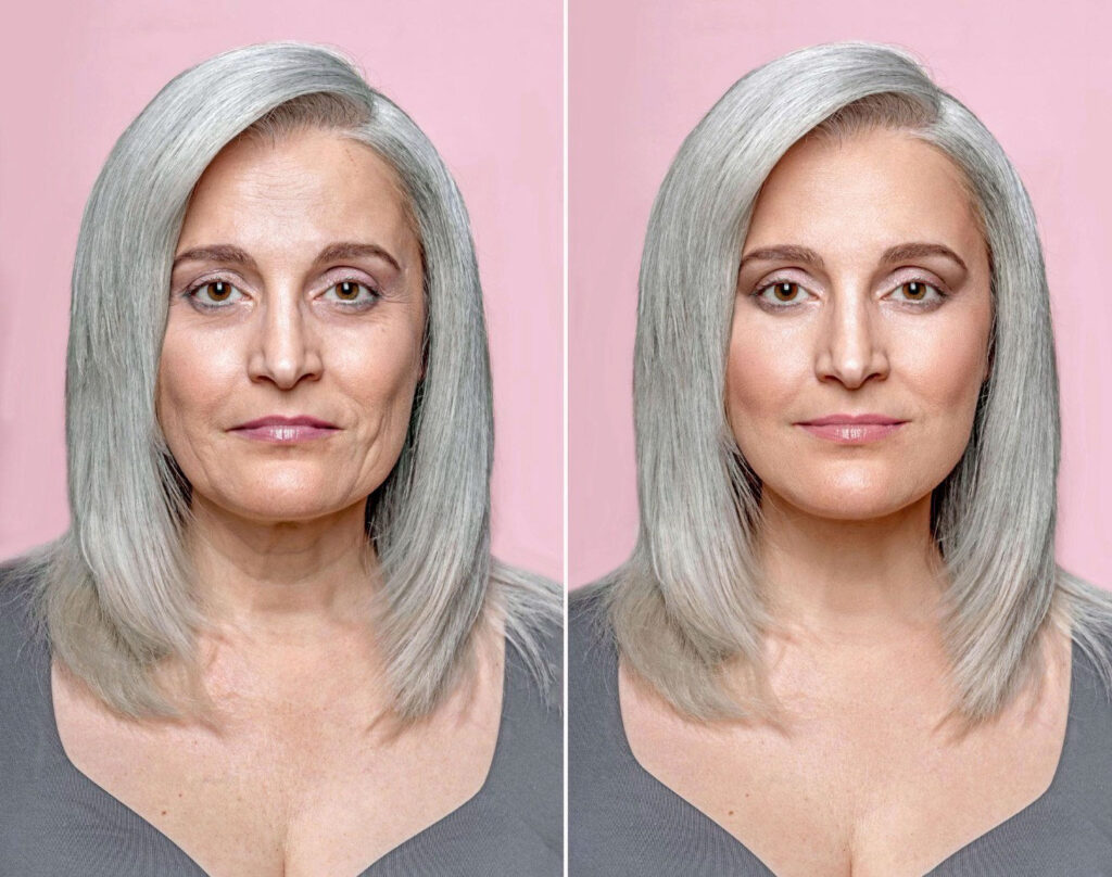 sculptra รีวิว